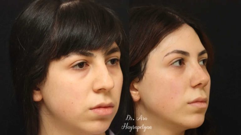 ринопластика