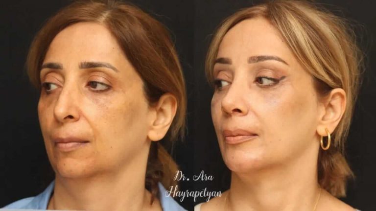 ринопластика и подтяжка бровей