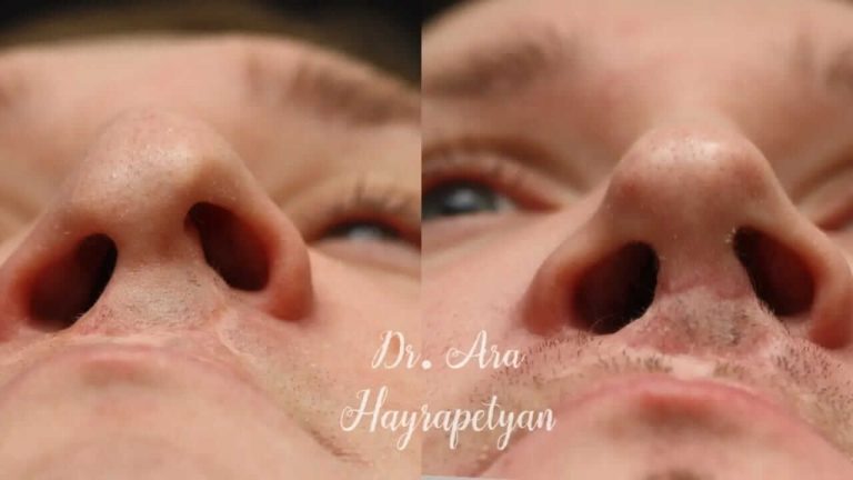 ринопластика фото до и после