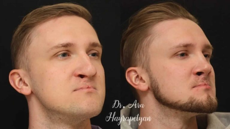 ринопластика фото до и после