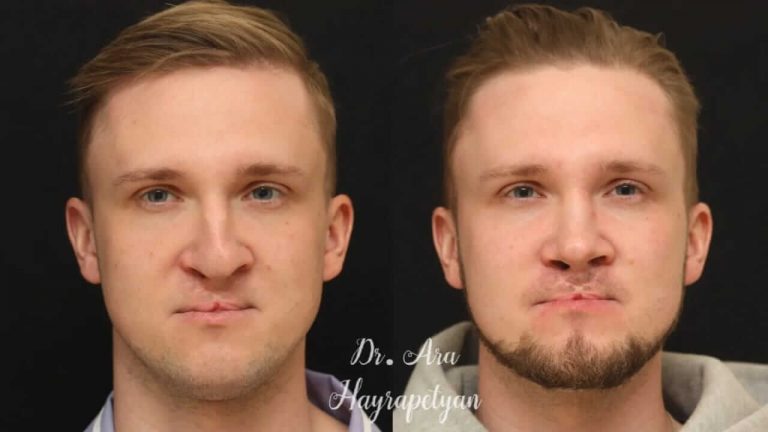 ринопластика фото до и после