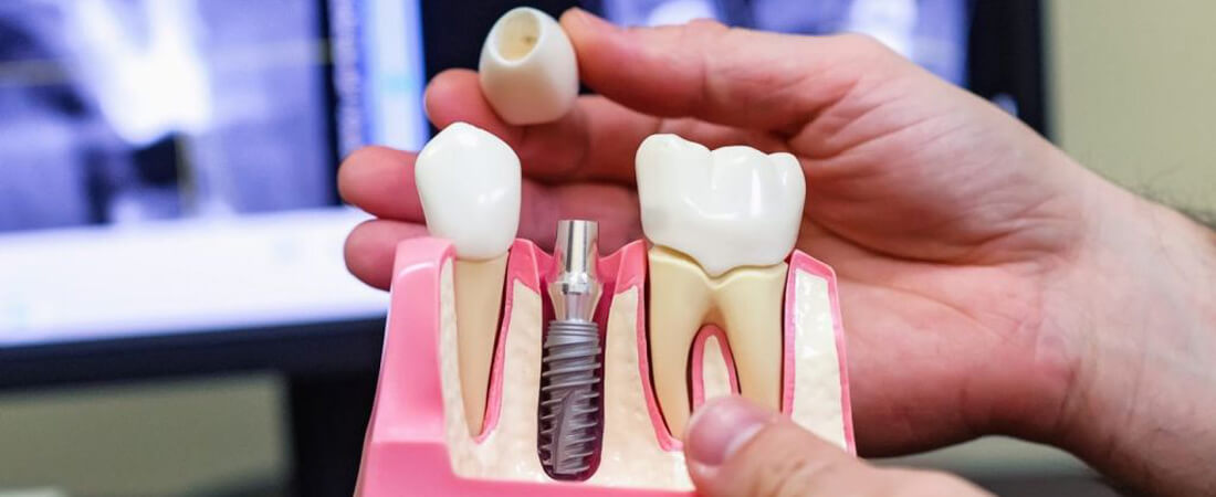 Установка зубных имплантатов
