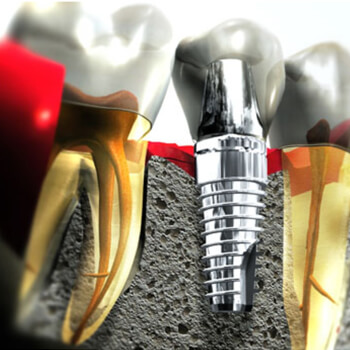 Установка зубных имплантатов