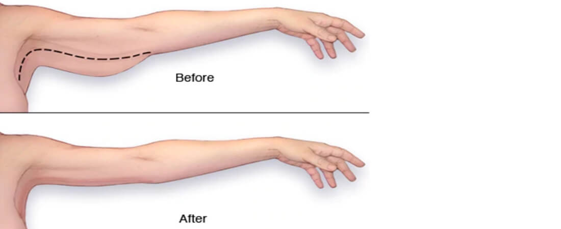 Брахиопластика или подтяжка рук
