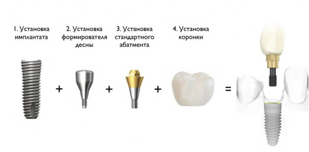 Имплантация зубов в Ереване