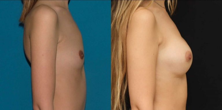 Увеличение груди грудными имплантатами
