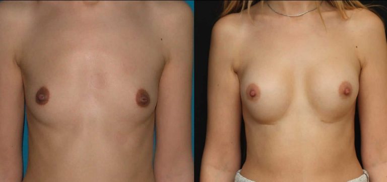 Увеличение груди грудными имплантатами